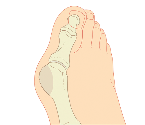 Hallux valgus